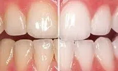 Tại sao răng lại bị chuyển màu ố vàng