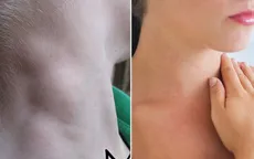 Nổi hạch ở cổ có phải là ung thư?