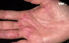 Bệnh lý "đôi tay người nội trợ"