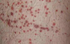 Bệnh rối loạn sinh tủy nguy hiểm như thế nào?