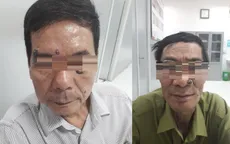 Ung thư tế bào đáy - Những điều cần biết về loại ung thư da hay gặp nhất