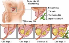 Điều trị ung thư tuyến tiền liệt di căn