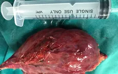 Phẫu thuật nội soi cắt bỏ khối u trung thất khổng lồ