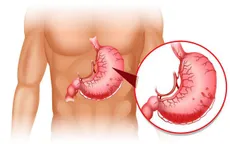 Quy tắc 9 "không" cho người đau dạ dày