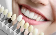 Các phương pháp làm trắng răng