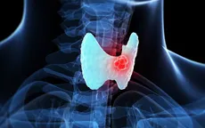 Điều trị ung thư tuyến giáp - Nguyên tắc cần biết