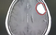 Đau đầu dữ dội, phát hiện bị u não trán trái