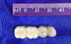 Hy hữu: Cụ ông 90 tuổi bị rơi cầu răng giả 4 chiếc vào phế quản