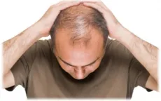 Phương pháp chữa trị bệnh hói đầu