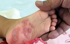 Một trẻ tử vong do bệnh tay chân miệng ở Bến Tre