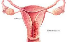Lạc nội mạc tử cung và hiếm muộn ở nữ giới