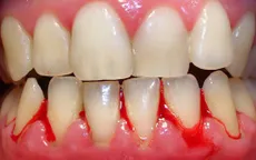 Chảy máu chân răng có nguy hiểm không?