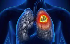 10 dấu hiệu cảnh báo ung thư phổi