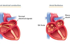 Phát hiện dấu ấn sinh học mới trong điều trị bệnh tim