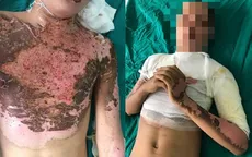 Bỏng nặng vì tự chế pháo theo hướng dẫn trên mạng