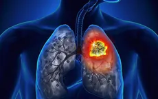 Ung thư phổi giai đoạn sớm, các yếu tố nguy cơ không thể bỏ qua