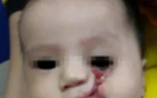 Phẫu thuật thành công cho bé trai có khe hở chéo mặt hiếm gặp