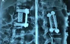 3 ca mổ liên tiếp cứu người đàn ông bị rơi từ độ cao 8m