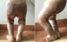 Hỗ trợ điều trị cho bé trai bị bỏng, sẹo co rút nặng