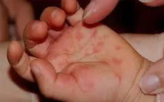 Bệnh tay chân miệng khó phát hiện, dễ bị nhầm với một số bệnh khác