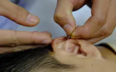 Châm cứu - Phương pháp hiệu quả trong điều trị rối loạn giấc ngủ