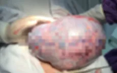 Cụ bà 81 tuổi mang khối u buồng trứng nặng hơn 3kg
