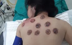 Nguy cơ hoại tử da khi đi giác hơi