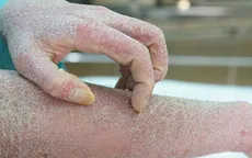 Khám, tư vấn miễn phí cho bệnh nhân vảy nến tại Hà Nội