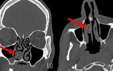Người đàn ông có "bưu kiện ma túy" mắc kẹt trong mũi suốt… 18 năm