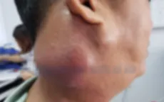 Khối u di căn vì tin lời thầy lang "nổi tiếng" đắp lá chữa ung thư