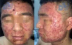 Bùng phát trứng cá do sử dụng thuốc nam không rõ nguồn gốc
