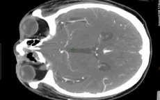 Đau vùng trán kéo dài - triệu chứng sớm của bệnh lý nguy hiểm