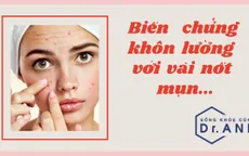 Biến chứng khôn lường khi chủ quan với vài nốt mụn
