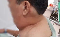 Uống 1 lít rượu mỗi ngày, biến dạng mặt, cổ vì... u mỡ
