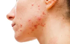 10 nguy cơ không ngờ từ dầu dừa