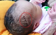 Bé sơ sinh bị dao cắt rách da đầu