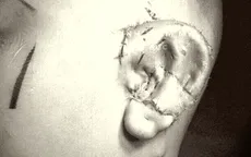 Phẫu thuật thành công kỹ thuật tạo hình tai nhỏ microtia tiên tiến nhất thế giới