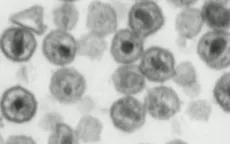 Chủng mới của virus HIV có thể là thách thức cho các xét nghiệm chẩn đoán