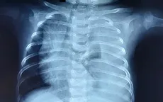 Cứu bé 3 tháng tuổi phổi trắng xóa vì rò dịch dưỡng chấp