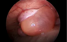 Thoát vị bẹn ở trẻ em - bệnh lý thường gặp nhưng nguy hiểm