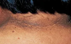 Biểu hiện da trên bệnh nhân đái tháo đường