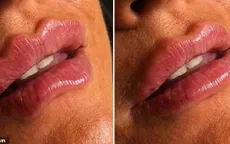 "Hết hồn" với trào lưu môi gợn sóng tại Anh