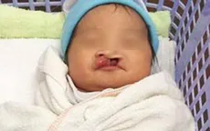 Bé gái hở hàm ếch bị bỏ rơi giữa chợ ở Kiên Giang