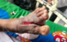 Vào viện do nhiễm trùng nặng bàn chân mới phát hiện mắc đái tháo đường