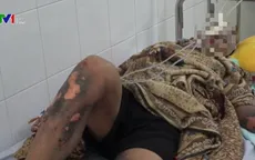 Thanh niên 16 tuổi bị bỏng nặng vì sử dụng điện thoại trong lúc sạc