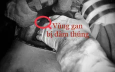 Báo động đỏ cứu nam thanh niên bị thủng tim, gan nguy kịch