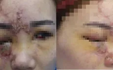 Tiêm chất làm đầy: lưu ý các vùng nguy hiểm