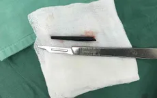 Lấy dị vật hình trụ dài 5cm trong sàn hốc mắt nam thanh niên