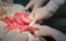Bé trai 3 tuổi bị tắc ruột cấp cứu... do giun