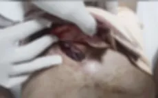 Hoàn cảnh đáng thương của bé trai 13 tuổi bị thanh sắt đâm thấu ngực bụng